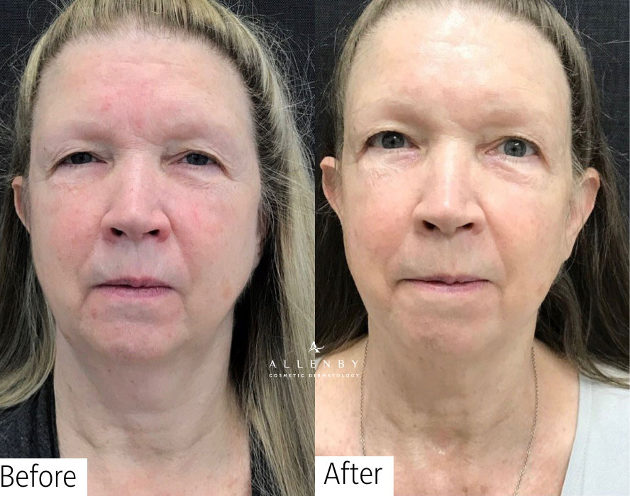 Virtue RF Before and After Photo by Allenby Cosmetic Dermatology in Delray Beach, FL