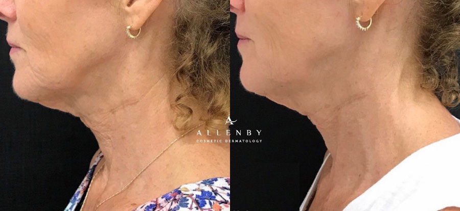 Vivace Before and After Photo by Allenby Cosmetic Dermatology in Delray Beach, FL