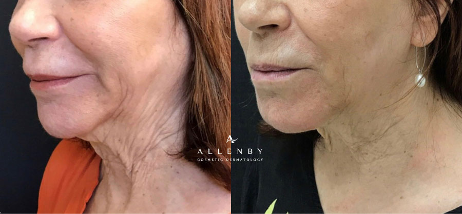 Vivace Before and After Photo by Allenby Cosmetic Dermatology in Delray Beach, FL