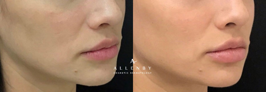 Juvederm Voluma XC Before and After Photo by Allenby Cosmetic Dermatology in Delray Beach, FL
