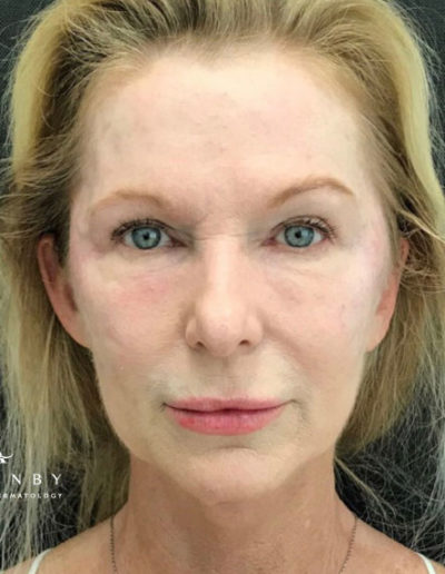 Eye Threadlift After Photo by Dr. Janet Allenby in Delray Beach, FL