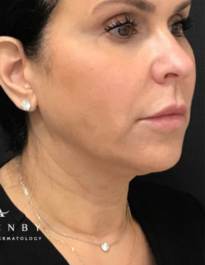 European Peel After Photo by Dr. Janet Allenby in Delray Beach, FL