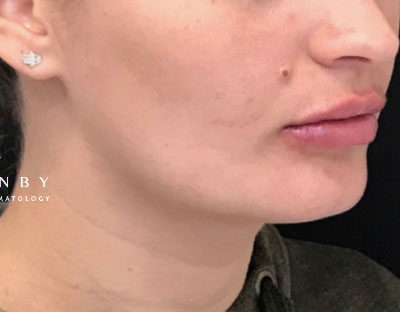 Juvederm Lips After Photo by Dr. Janet Allenby in Delray Beach, FL