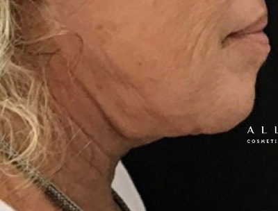 Restylane Lyft Before Photo by Dr. Janet Allenby in Delray Beach, FL