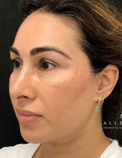 Obagi Nu-Derm Before Photo by Dr. Janet Allenby in Delray Beach, FL