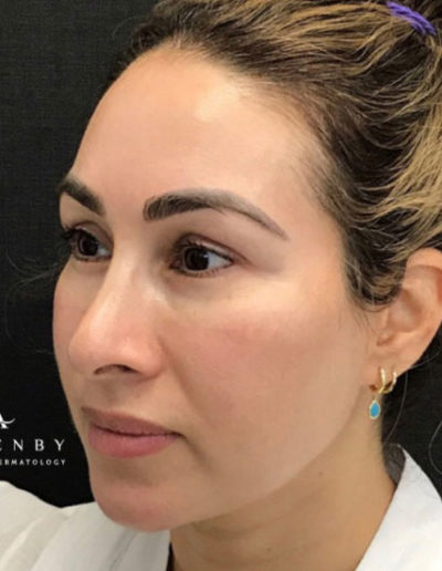 Obagi Nu-Derm After Photo by Dr. Janet Allenby in Delray Beach, FL