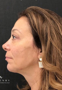 Restylane Lyft After Photo by Dr. Janet Allenby in Delray Beach, FL