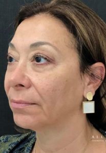Restylane Lyft Before Photo by Dr. Janet Allenby in Delray Beach, FL