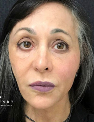 Sculptra® and Threadlift After Photo by Dr. Janet Allenby in Delray Beach, FL