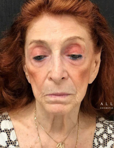 Sculptra® and Threadlift Before Photo by Dr. Janet Allenby in Delray Beach, FL