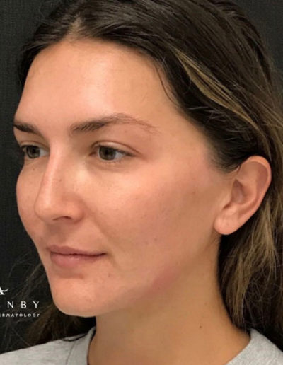 Threadlift, Jaw line and Cheek filler After Photo by Dr. Janet Allenby in Delray Beach, FL