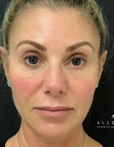 Threadlift Before Photo by Dr. Janet Allenby in Delray Beach, FL