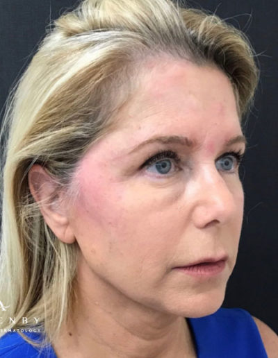 Threadlift After Photo by Dr. Janet Allenby in Delray Beach, FL