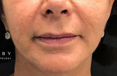Thread Lip Lift After Photo by Dr. Janet Allenby in Delray Beach, FL