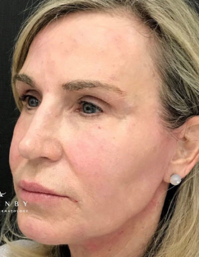 Threadlift After Photo by Dr. Janet Allenby in Delray Beach, FL