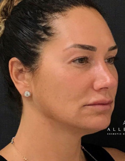 Threadlift Before Photo by Dr. Janet Allenby in Delray Beach, FL