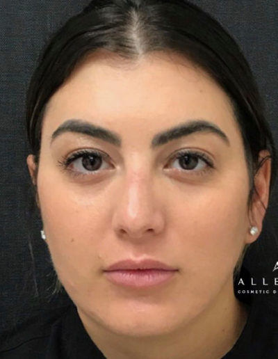 Threadlift, Cheeks and Jaw line filler Before Photo by Dr. Janet Allenby in Delray Beach, FL