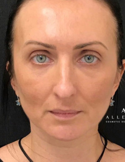 Versa Lips and Sculptra After Photo by Dr. Janet Allenby in Delray Beach, FL