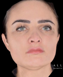 AccuTite Before and After Photo by Dr. Janet Allenby of Delray Beach, FL