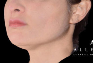 AccuTite Before Photo by Dr. Janet Allenby in Delray Beach, FL