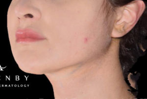 AccuTite After Photo by Dr. Janet Allenby in Delray Beach, FL