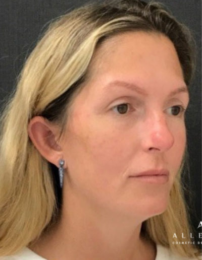 Cheek Filler Before Photo by Dr. Janet Allenby in Delray Beach, FL