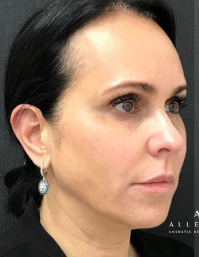 Chin, Cheek and Jaw Line Filler Before Photo by Dr. Janet Allenby in Delray Beach, FL