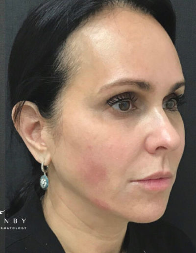 Chin, Cheek and Jaw Line Filler After Photo by Dr. Janet Allenby in Delray Beach, FL