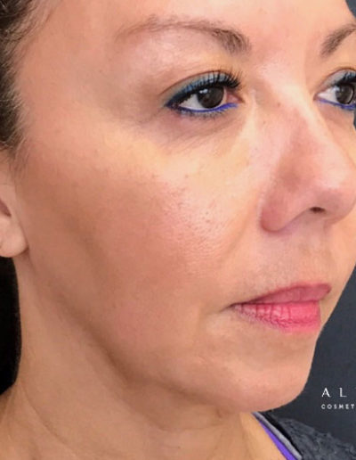 Jaw Threadlift Before Photo by Dr. Janet Allenby in Delray Beach, FL