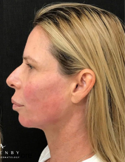 Chin and Jaw Line Filler After Photo by Dr. Janet Allenby in Delray Beach, FL
