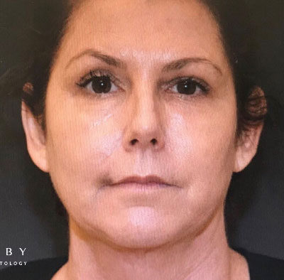 Kybella Under Eye After Photo by Dr. Janet Allenby in Delray Beach, FL
