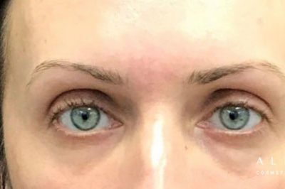Microblading Before Photo by Dr. Janet Allenby in Delray Beach, FL