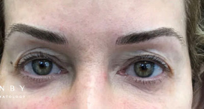 Microblading After Photo by Dr. Janet Allenby in Delray Beach, FL
