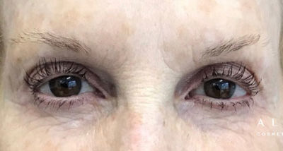 Microblading Before Photo by Dr. Janet Allenby in Delray Beach, FL