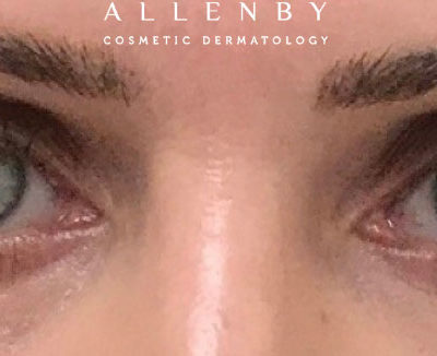 Nu-Cil™ Eyelash Enhancing Serum After Photo by Dr. Janet Allenby in Delray Beach, FL