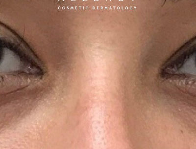 Nu-Cil™ Eyelash Enhancing Serum After Photo by Dr. Janet Allenby in Delray Beach, FL