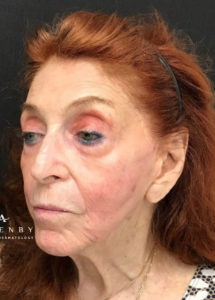 Sculptra® and Threadlift After Photo by Dr. Janet Allenby in Delray Beach, FL