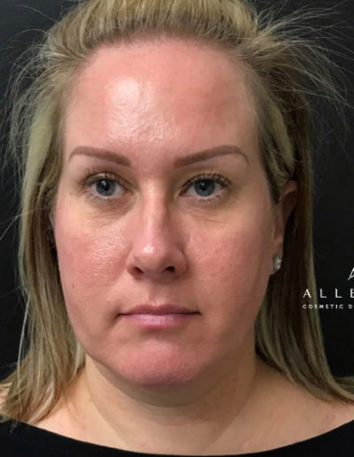 Ultherapy Before Photo by Dr. Janet Allenby in Delray Beach, FL