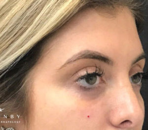 Under eye filler After Photo by Dr. Janet Allenby in Delray Beach, FL
