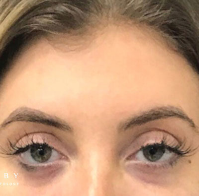 Under eye filler After Photo by Dr. Janet Allenby in Delray Beach, FL