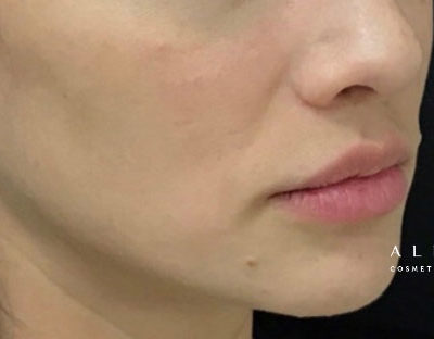 Juvederm Voluma in Lips Before Photo by Dr. Janet Allenby in Delray Beach, FL