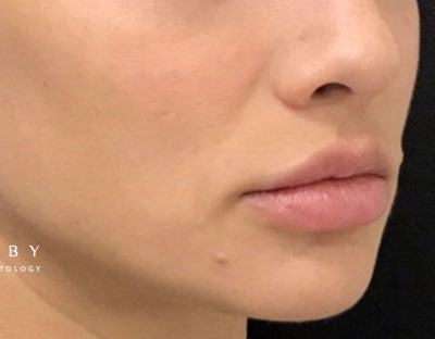 Juvederm Voluma in Lips After Photo by Dr. Janet Allenby in Delray Beach, FL