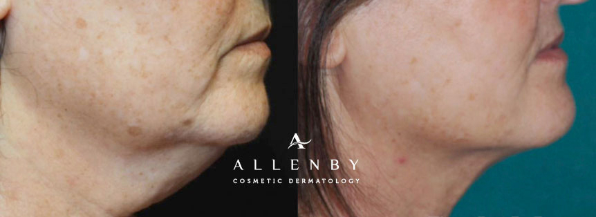 accutite before and after patient
