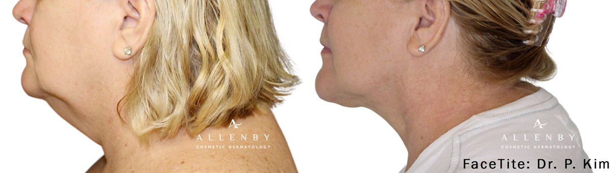 FaceTite before and after image of real patient at Allenby Dermatology