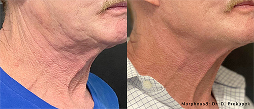 Morpheus8 before and after image of real patient at Allenby Dermatology