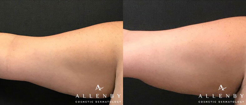 Cellfina Before and After Photo by Allenby Cosmetic Dermatology in Delray Beach, FL